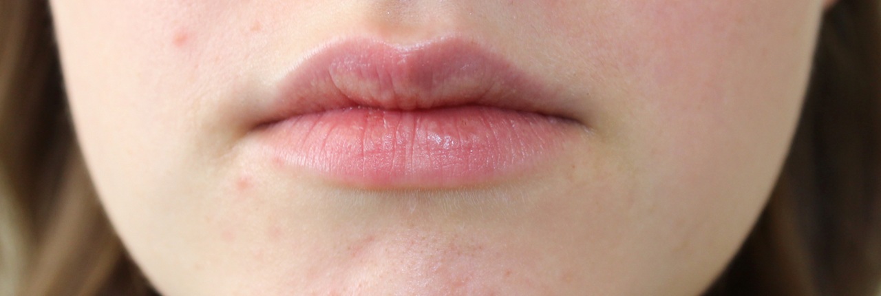 Dermatite perioral